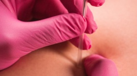 Suche igłowanie – po co wbijać igłę, skoro i tak boli? Zdrowie, LIFESTYLE - Wbrew pozorom suche igłowanie nie ma nic wspólnego z akupunkturą i medycyną chińską.